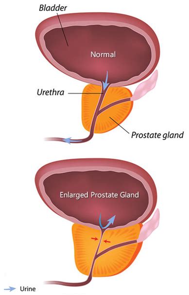 hipertensiune arterială hiperplazie benignă de prostată